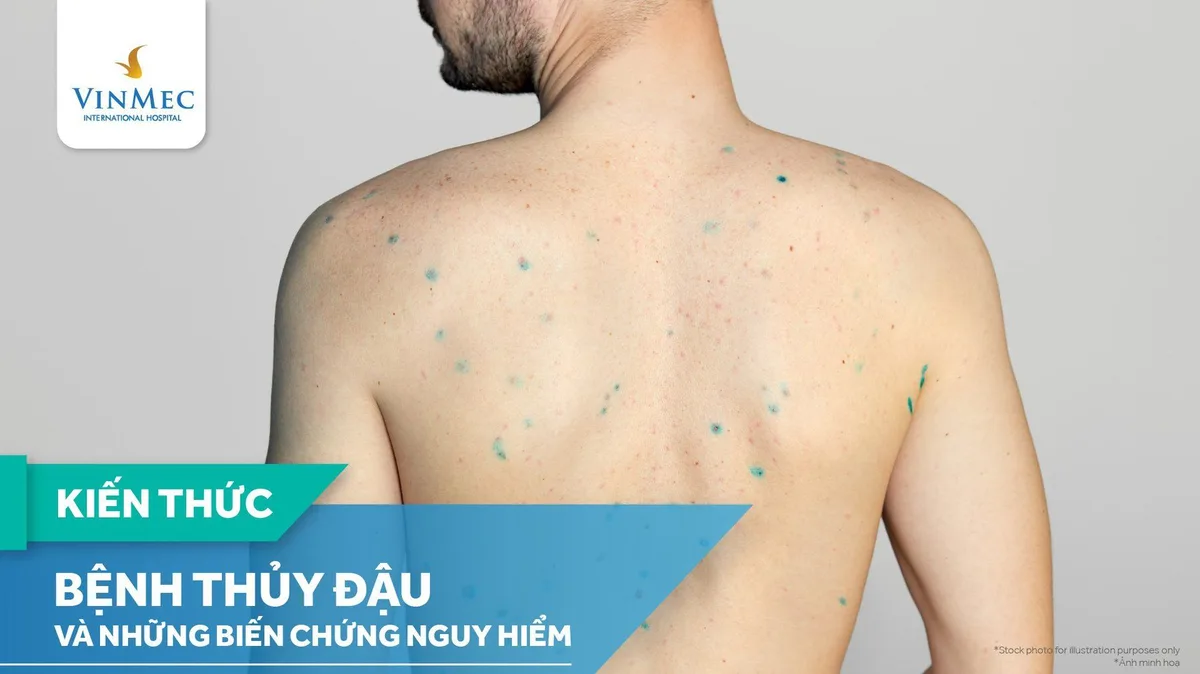 โรคอีสุกอีใส: รู้ก่อนป่วย! อาการ สาเหตุ การรักษา