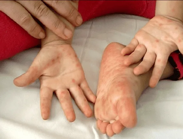มือเท้าปาก