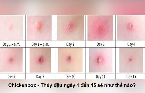 Bệnh thủy đậu: Nguyên nhân, triệu chứng, biến chứng và cách điều trị