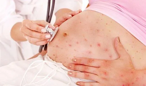 Bệnh thủy đậu: Nguyên nhân, triệu chứng, biến chứng và cách điều trị