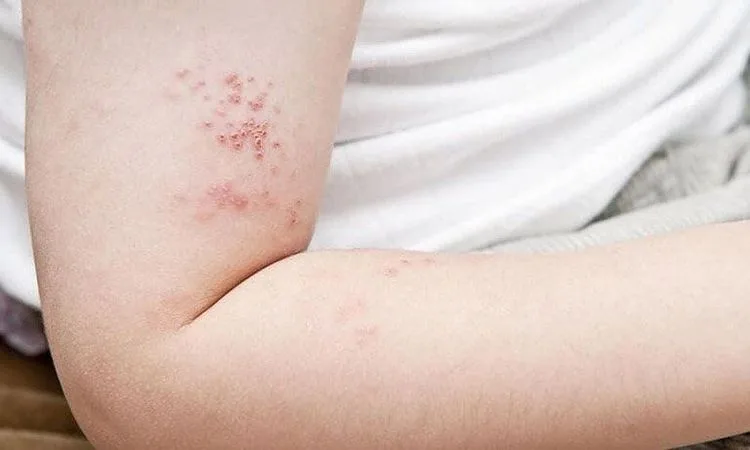 Bệnh zona thần kinh có lây không?