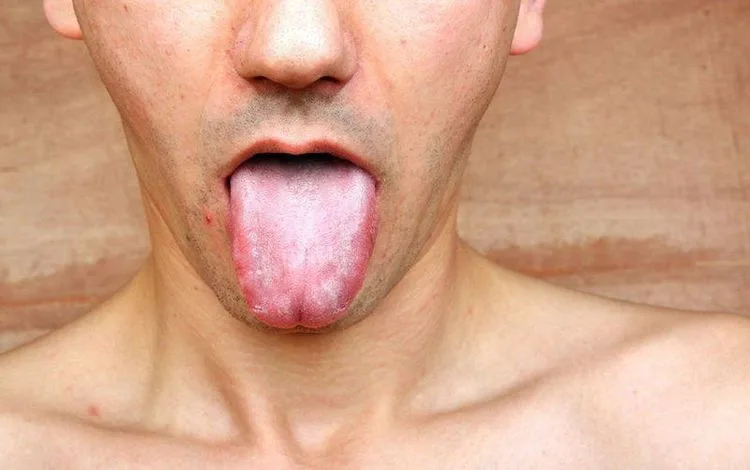 Bệnh giang mai: Nguyên nhân, đường lây, dấu hiệu nhận biết