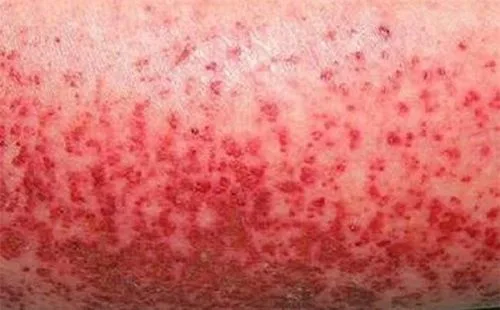 Sốt xuất huyết ở người lớn: Triệu chứng và cách điều trị