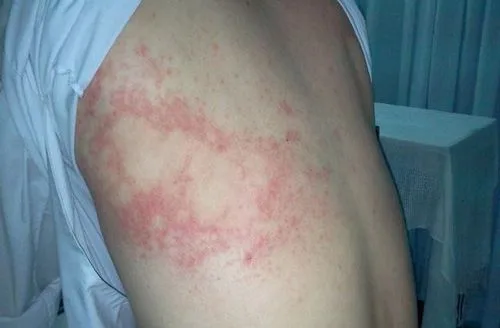 Các dấu hiệu nhiễm sán chó