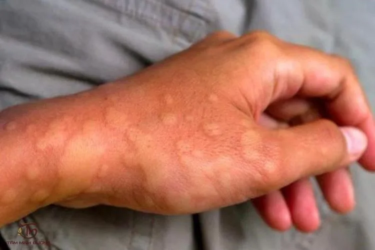 ผื่นลมพิษ: 5 สาเหตุที่คุณอาจไม่รู้ พร้อมวิธีรับมือฉุกเฉิน
