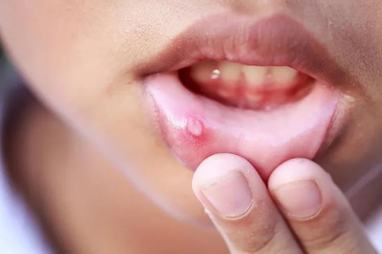 วิธีรักษาแผลในปากให้หายเร็ว: 5 เคล็ดลับจากแพทย์