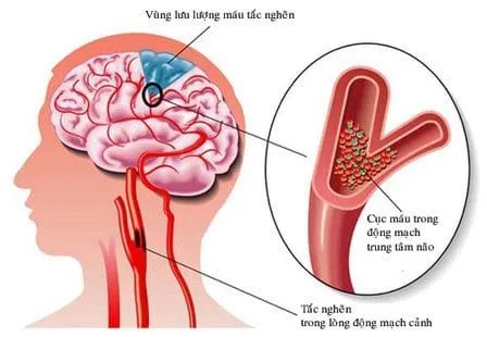 สาเหตุของโรคหลอดเลือดสมองเกิดจากความผิดปกติของการไหลเวียนเลือดในสมอง