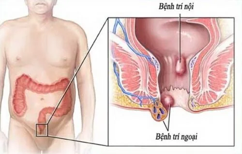 อุจจาระมีเลือดสด: 7 สาเหตุและวิธีรักษาที่ควรรู้ | ถ่ายเป็นเลือดสด