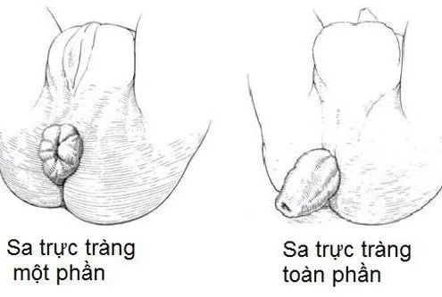 บางกรณีของภาวะลำไส้ตรงปลิ้น อาจทำให้เกิดอาการอุจจาระเป็นเลือดได้