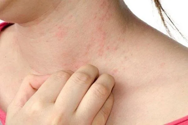 ผื่นคันทั่วตัวเกิดจากอะไร? 5 สาเหตุที่พบบ่อย พร้อมวิธีรับมือ