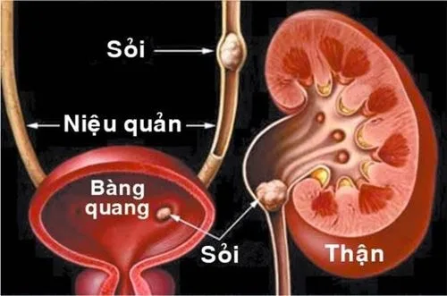 นิ่วในไตและสิ่งแปลกปลอมในทางเดินปัสสาวะอาจเป็นสาเหตุของการปัสสาวะบ่อย